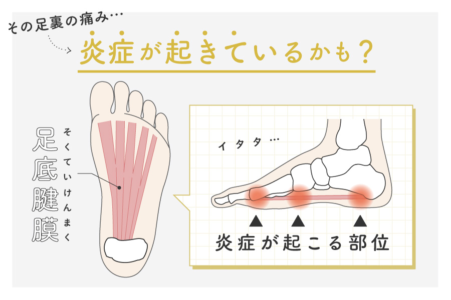 足底腱膜炎かも？