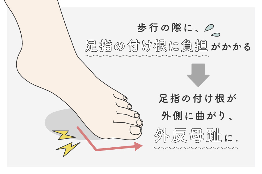 足の指の付け根に負担がかかり外反母趾に