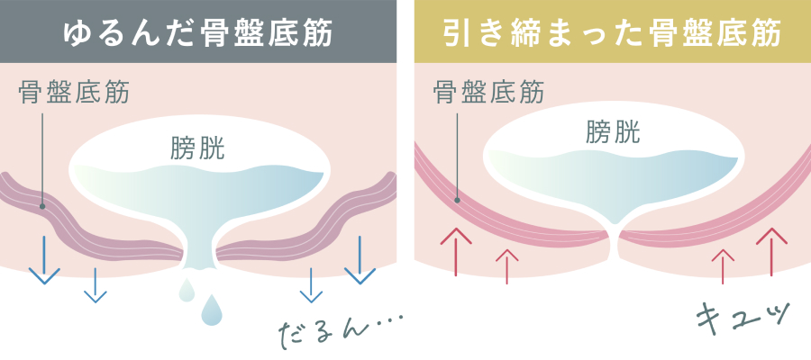 引き締まった骨盤底筋と緩んだ骨盤底筋